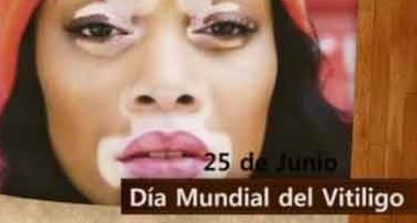 D&iacute;a Mundial del Vitiligo