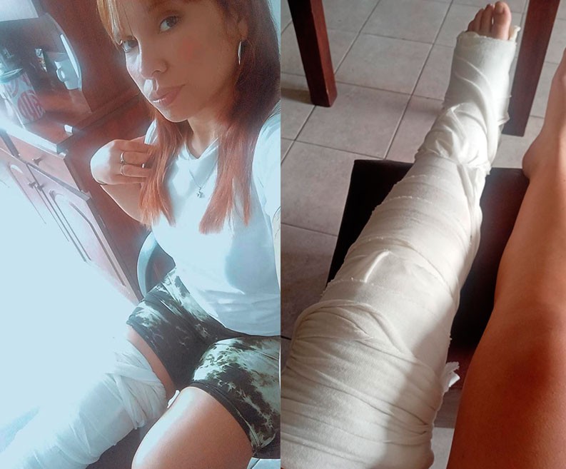 Campa&ntilde;a Solidaria para Luc&iacute;a Ver&oacute;nica Cabrera, tras sufrir una lesi&oacute;n importante trabajando como delivery en su motocicleta